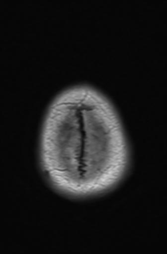 Acoustic schwannoma - probable (Radiopaedia 20386-20292 Axial T1 18).jpg