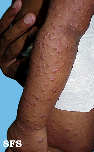Acrodermatitis Infantile Papular (Dermatology Atlas 8).jpg