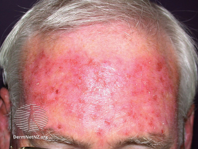 Actinic Keratoses treated with imiquimod (DermNet NZ lesions-ak-imiquimod-3741).jpg