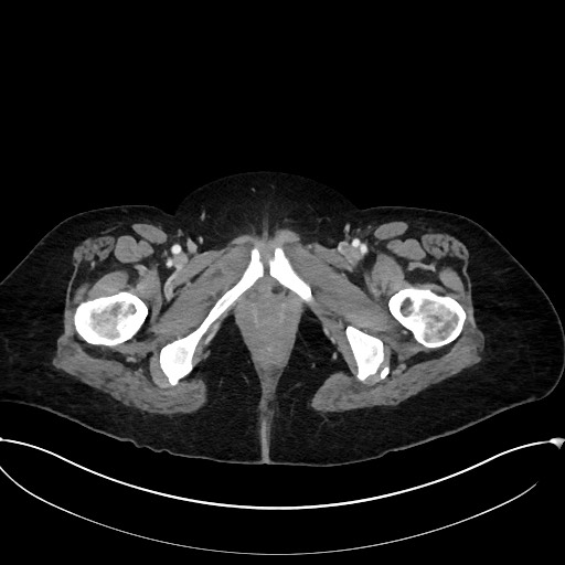 Active Crohn disease (Radiopaedia 59394-66750 Axial C+ portal venous phase 74).jpg