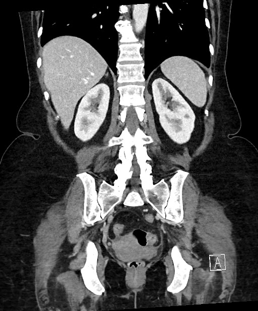 Active Crohn disease (Radiopaedia 59394-66750 Coronal C+ portal venous phase 50).jpg