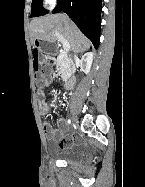 Active crohn disease (Radiopaedia 87133-103397 Sagittal C+ arterial phase 34).jpg