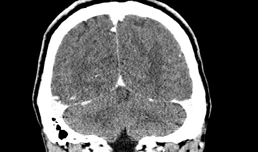 File:Active neurocysticercosis before and after therapy (Radiopaedia 71710-82099 Coronal 32).jpg