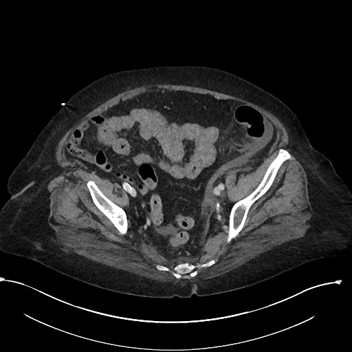 File:Active renal extravasation with large subcapsular and retroperitoneal hemorrhage (Radiopaedia 60975-68796 Axial 284).jpg