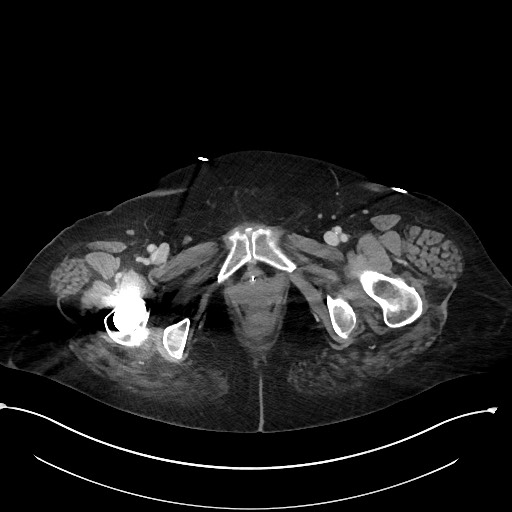 File:Active renal extravasation with large subcapsular and retroperitoneal hemorrhage (Radiopaedia 60975-68796 Axial 340).jpg