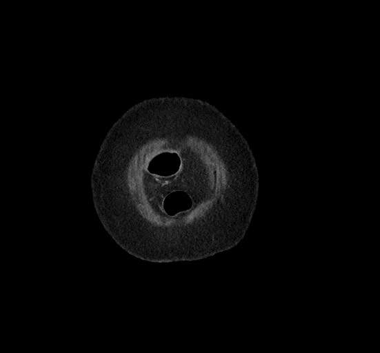 Active renal extravasation with large subcapsular and retroperitoneal hemorrhage (Radiopaedia 60975-68796 Coronal C+ portal venous phase 14).jpg