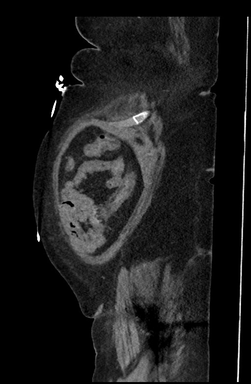 Active renal extravasation with large subcapsular and retroperitoneal hemorrhage (Radiopaedia 60975-68796 Sagittal C+ portal venous phase 192).jpg