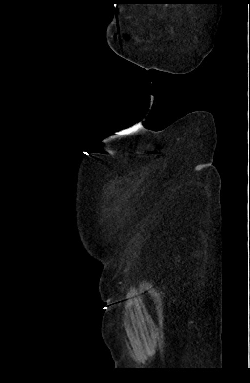 Active renal extravasation with large subcapsular and retroperitoneal hemorrhage (Radiopaedia 60975-68796 Sagittal C+ portal venous phase 30).jpg