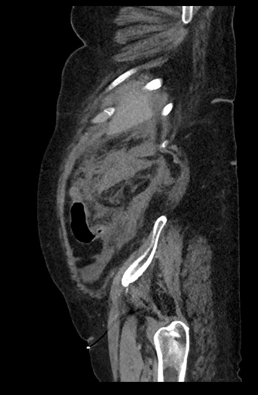Active renal extravasation with large subcapsular and retroperitoneal hemorrhage (Radiopaedia 60975-68796 Sagittal C+ portal venous phase 54).jpg