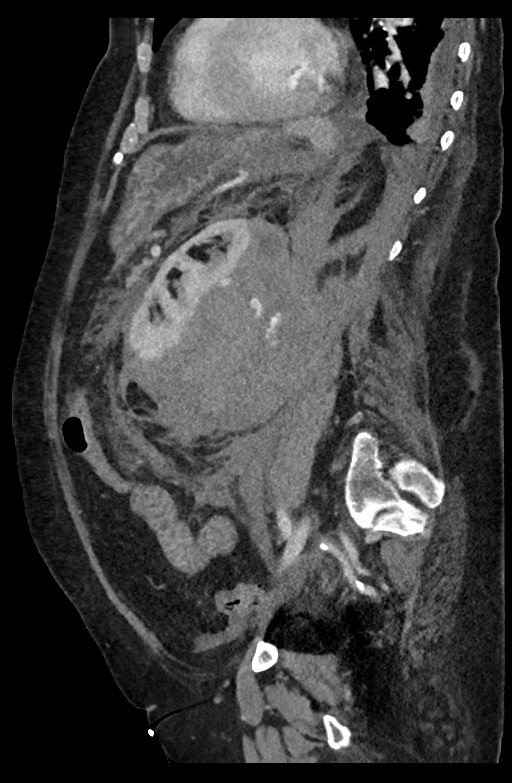 Active renal extravasation with large subcapsular and retroperitoneal hemorrhage (Radiopaedia 60975-68796 Sagittal C+ portal venous phase 90).jpg