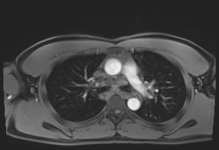 Active right ventricular cardiac sarcoidosis (Radiopaedia 55596-62100 Axial Post contrast Dixon 22).jpg
