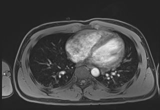 File:Active right ventricular cardiac sarcoidosis (Radiopaedia 55596-62100 Axial Post contrast Dixon 48).jpg