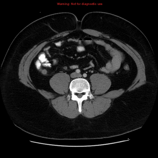 File:Acute appendicitis (Radiopaedia 12326-12607 Axial C+ portal venous phase 15).jpg