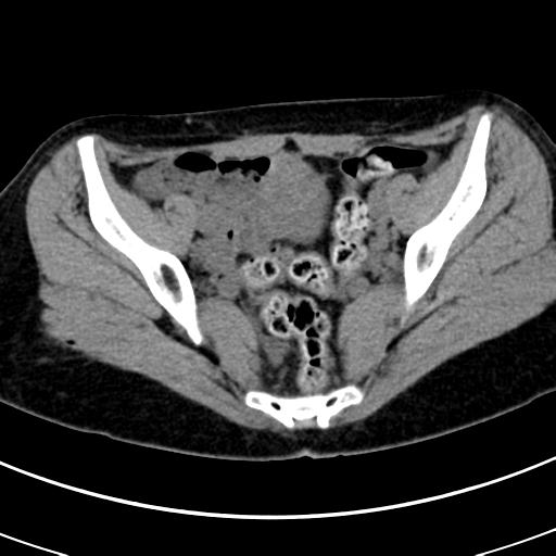 Acute appendicitis (Radiopaedia 30261-30888 Axial non-contrast 85).jpg