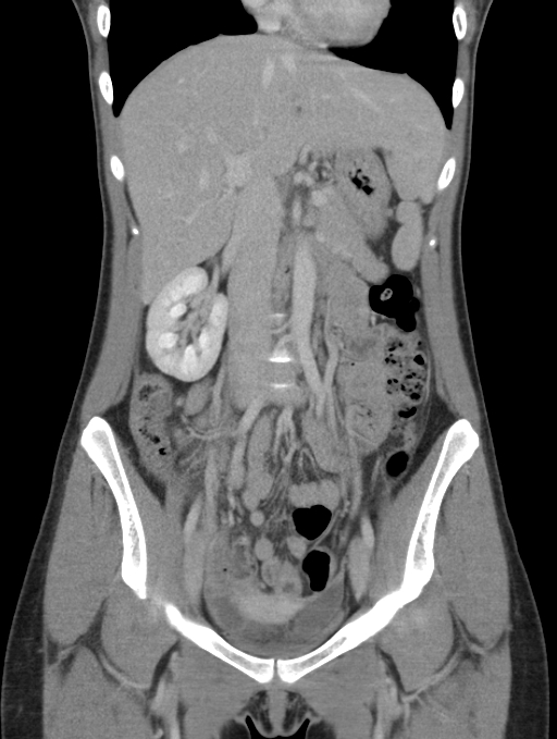 Acute appendicitis (Radiopaedia 62608-70901 Coronal C+ portal venous phase 19).jpg
