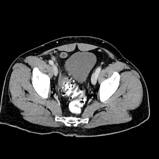 Acute appendicitis (Radiopaedia 77016-88960 Axial C+ portal venous phase 124).jpg