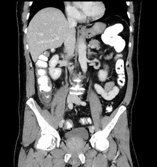 Acute appendicitis (Radiopaedia 77016-88960 Coronal C+ portal venous phase 53).jpg