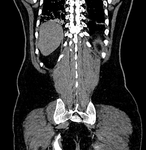 File:Acute appendicitis (Radiopaedia 79950-93224 Coronal C+ portal venous phase 80).jpg