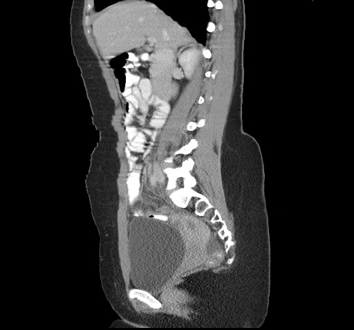 File:Acute appendicitis (Radiopaedia 9417-10099 Sagittal C+ portal venous phase 5).jpg
