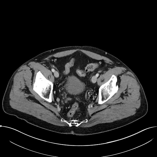 Acute appendicitis - large appendicoliths (Radiopaedia 61805-69820 Axial C+ portal venous phase 114).jpg