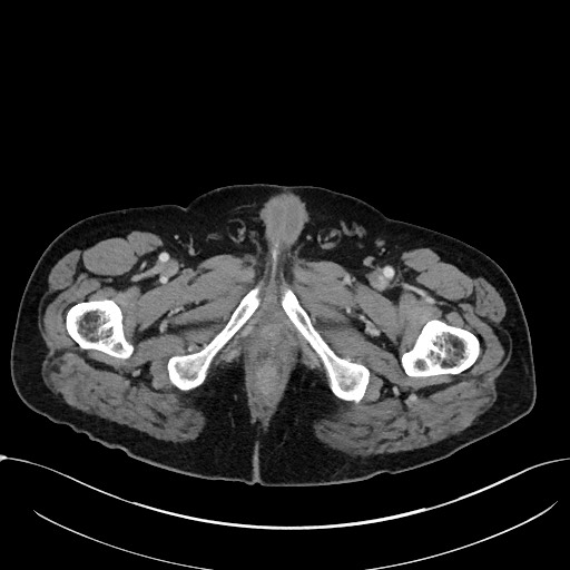 File:Acute appendicitis - large appendicoliths (Radiopaedia 61805-69820 Axial C+ portal venous phase 143).jpg