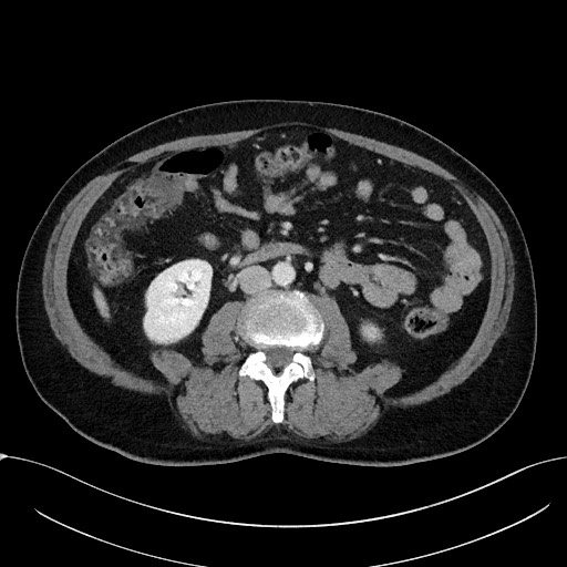 File:Acute appendicitis - large appendicoliths (Radiopaedia 61805-69820 Axial C+ portal venous phase 66).jpg