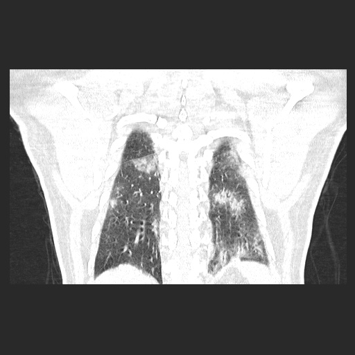 Acute appendicitis and COVID 19 pneumonia (Radiopaedia 76604-88380 G 53).jpg