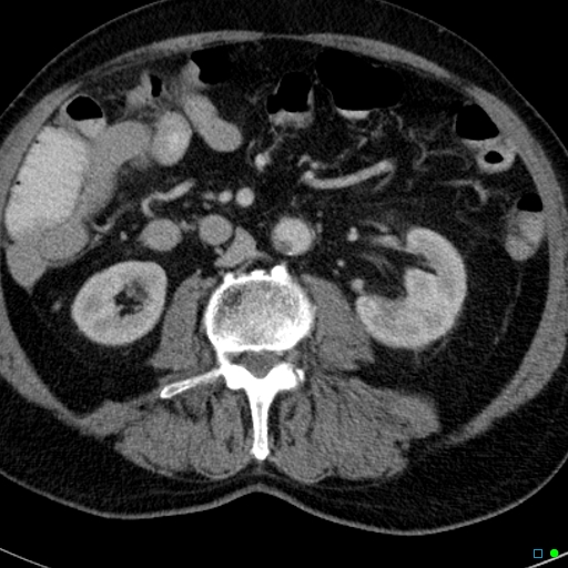 File:Acute appendicitis arising from a malrotated cecum (Radiopaedia 19970-19997 Axial C+ portal venous phase 14).jpg