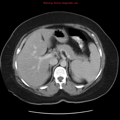 Acute appendicitis complicated by ovarian vein thrombophlebitis (Radiopaedia 16172-15851 Axial C+ portal venous phase 29).jpg