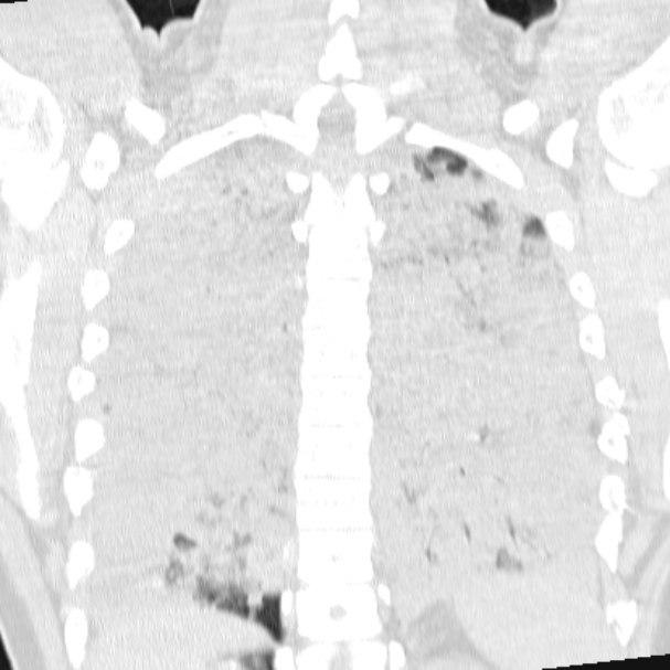 Acute aspiration pneumonitis (Radiopaedia 33605-34703 Coronal lung window 60).jpg