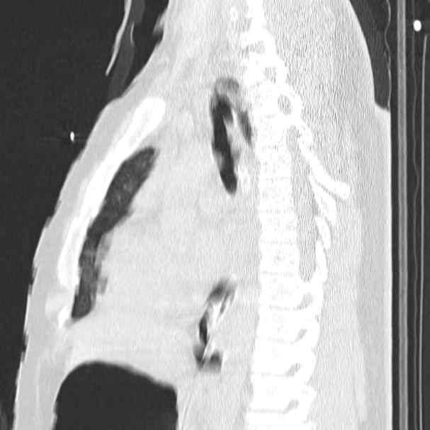 Acute aspiration pneumonitis (Radiopaedia 33605-34703 Sagittal lung window 46).jpg