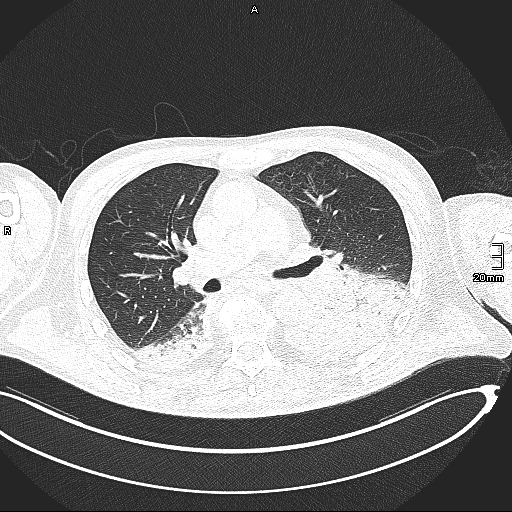 Acute aspiration pneumonitis (Radiopaedia 55642-62166 Axial lung window 73).jpg