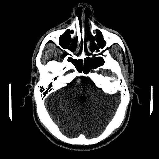 Acute basilar artery occlusion (Radiopaedia 43582-46985 Axial non-contrast 59).jpg