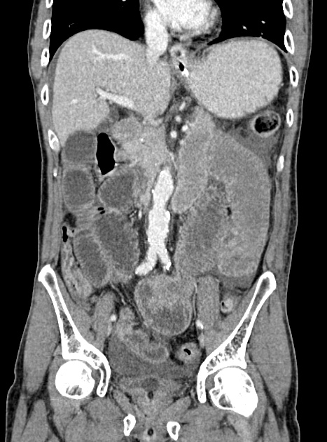 Acute bowel ischemia (Radiopaedia 87695-104114 Coronal C+ portal venous phase 197).jpg