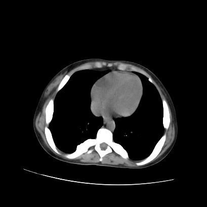 File:Acute calculous cholecystitis in patient with osteopetrosis (Radiopaedia 77871-90159 Axial non-contrast 11).jpg