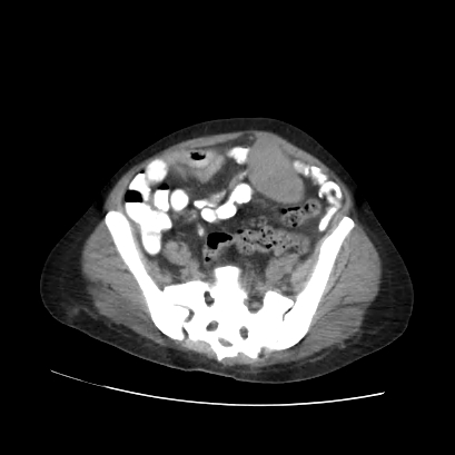File:Acute calculous cholecystitis in patient with osteopetrosis (Radiopaedia 77871-90159 Axial non-contrast 62).jpg