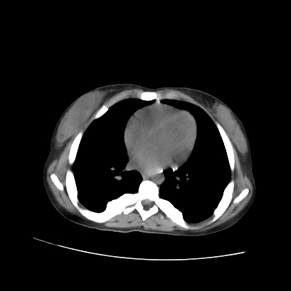 File:Acute calculous cholecystitis in patient with osteopetrosis (Radiopaedia 77871-90159 Axial non-contrast 7).jpg