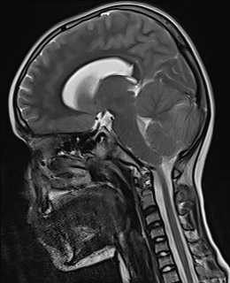 File:Acute cerebellar ataxia (Radiopaedia 61487-69446 Sagittal T2 5).jpg