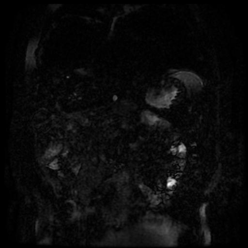 Acute cholecystitis and biliary hamartomas (Radiopaedia 86231-102240 E 137).jpg