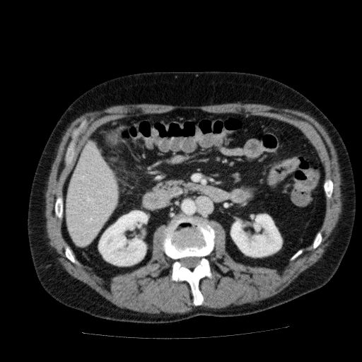 Acute cholecystitis and incidental left sided IVC (Radiopaedia 49352-54459 Axial C+ portal venous phase 69).jpg
