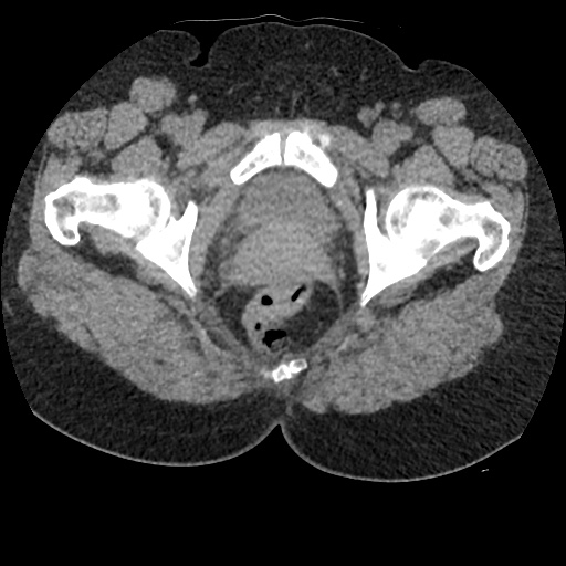 Acute cholecystitis and ureteric colic (Radiopaedia 42330-45444 Axial prone 109).jpg