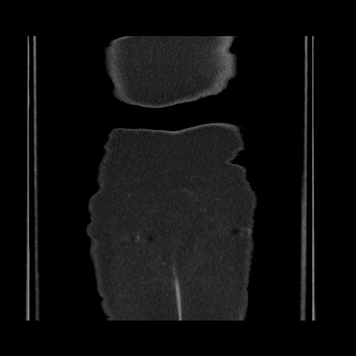 Acute cholecystitis with tensile fundus sign (Radiopaedia 71394-81723 Coronal non-contrast 125).jpg