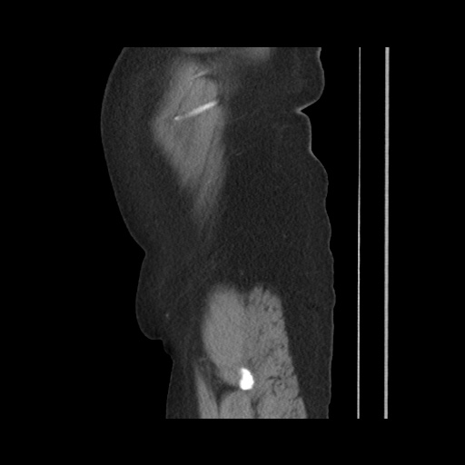 Acute cholecystitis with tensile fundus sign (Radiopaedia 71394-81723 Sagittal non-contrast 32).jpg