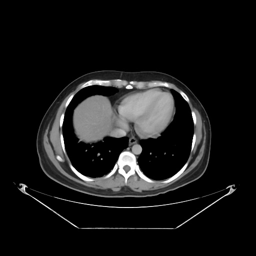 File:Acute complicated calculous cholecystitis (Radiopaedia 55202-61587 Axial C+ delayed 17).jpg