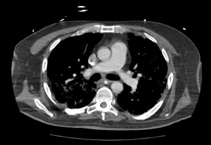 Acute cor pulmonale (ultrasound) (Radiopaedia 83508-98818 Axial C+ CTPA 32).jpg