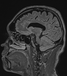 Acute disseminated encephalomyelitis (ADEM)- Anti-NMDA receptor encephalitis (Radiopaedia 54920-61201 Sagittal FLAIR 50).png