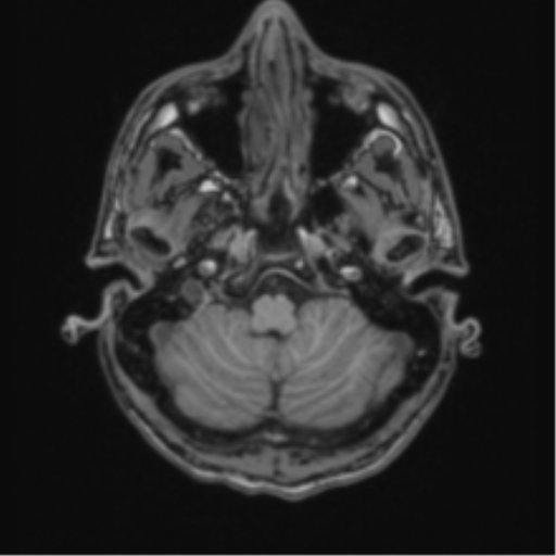 Acute disseminated encephalomyelitis (ADEM) (Radiopaedia 65319-74349 Axial T1 7).png