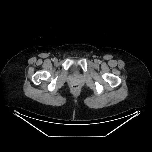 Acute diverticulitis - transverse colon (Radiopaedia 87063-103327 Axial C+ portal venous phase 169).jpg