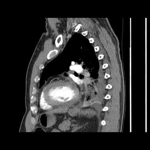 File:Acute epicardial fat necrosis (Radiopaedia 42327-45440 Sagittal C+ CTPA 46).jpg