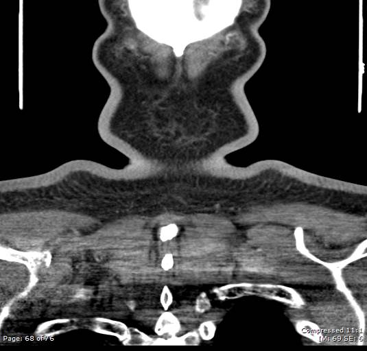 File:Acute epiglottitis (Radiopaedia 54375-60590 Coronal C+ arterial phase 68).jpg